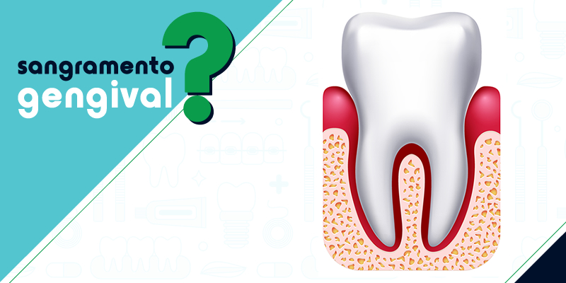 sangramento gengival, gengivite, doença periodontal, periodontitie, dentista, consultório odontológico